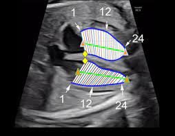 Fetal growth percentile software: a tool to calculate estimated fetal weight percentiles for 6 standards - Perinatology Research Branch